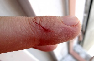 Open wound on finger. 